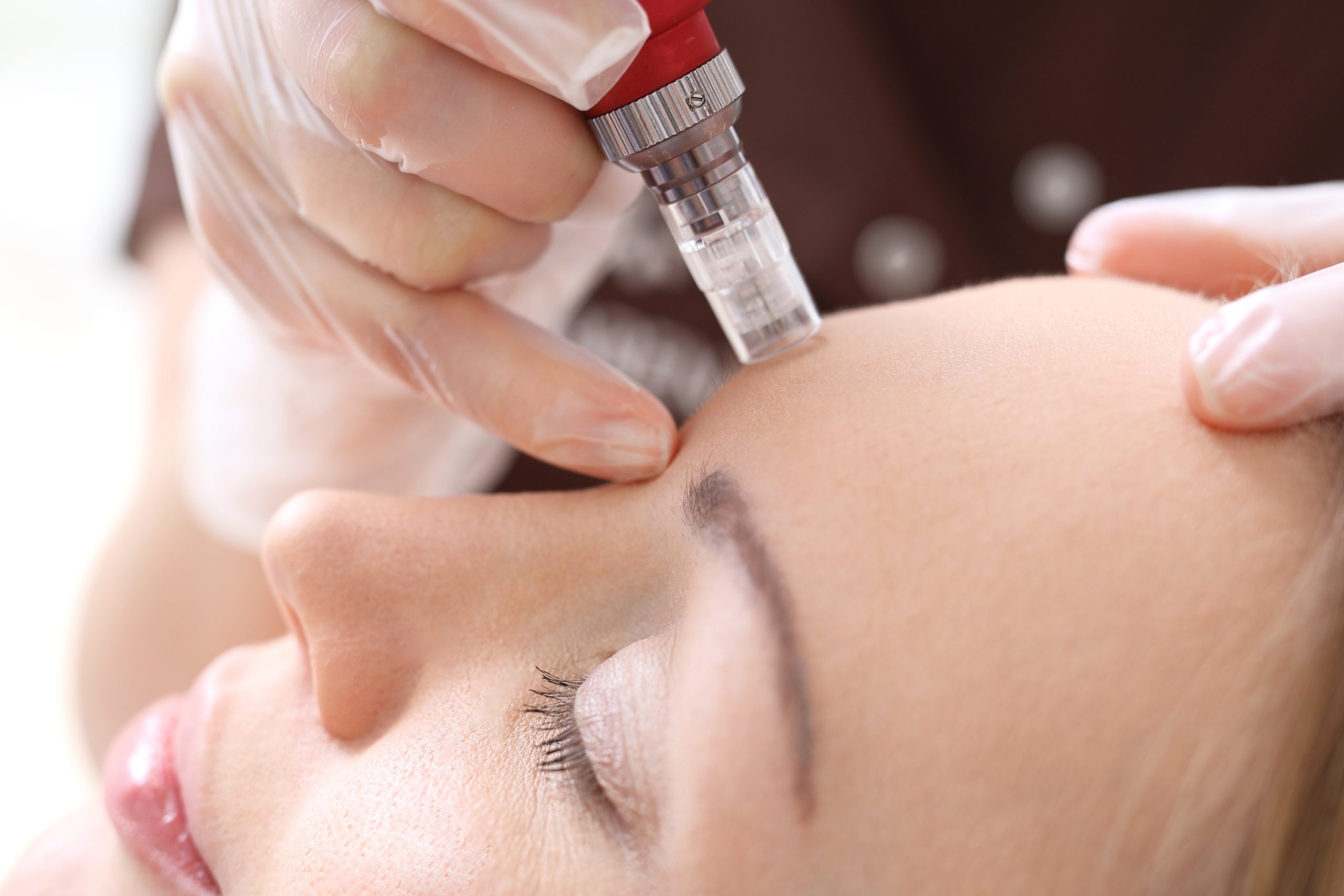 Microneedling for Scars Review: Skin Zone Aesthetic Clinic